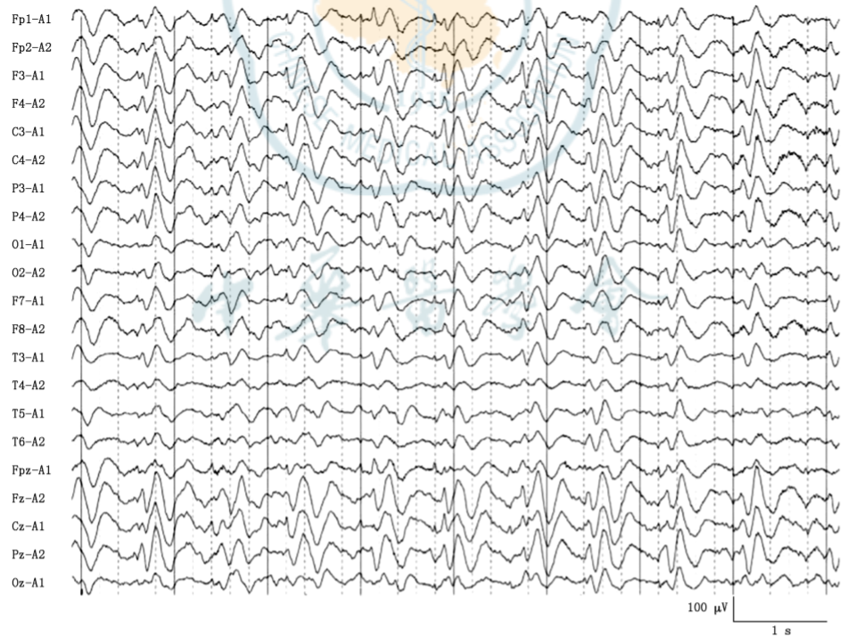 疯牛病的三相波脑电图图片