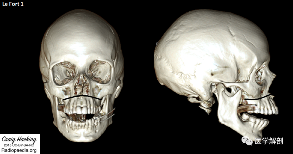 图文细说lefort骨折的分型
