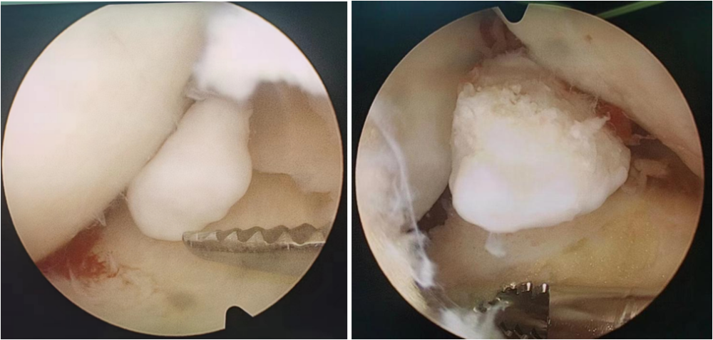 膝关节游离体,是由于各种原因出现在关节腔内的游离的物体,是造成膝