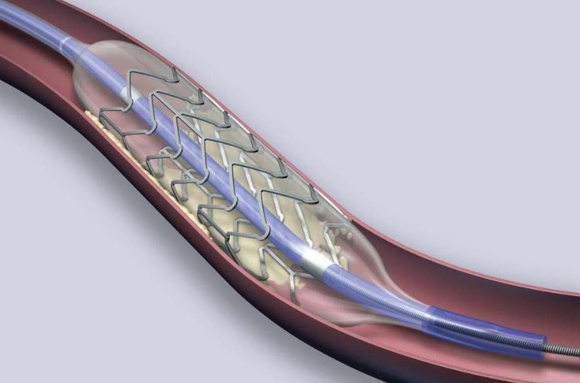 國內將逐漸停止心臟支架手術?支架利大還是弊大?_騰訊新聞