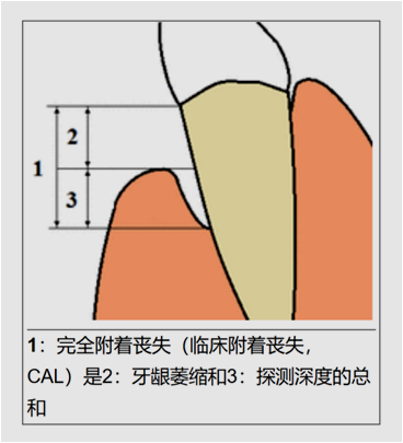如下图,而正常牙龈附着于牙颈部附近)并逐步发生退缩