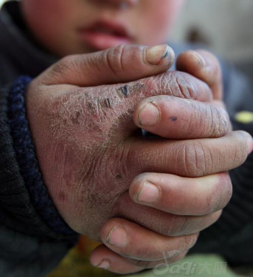 病,手啊脚啊都会很痒我们哪里叫"生冷冻"有的人一到冬天就会被冻伤,又