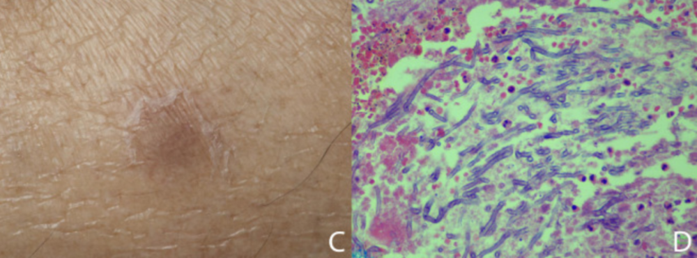 發現化膿性肉芽腫性炎症和真菌菌絲(圖d),皮膚組織培養呈黃麴黴菌陽性