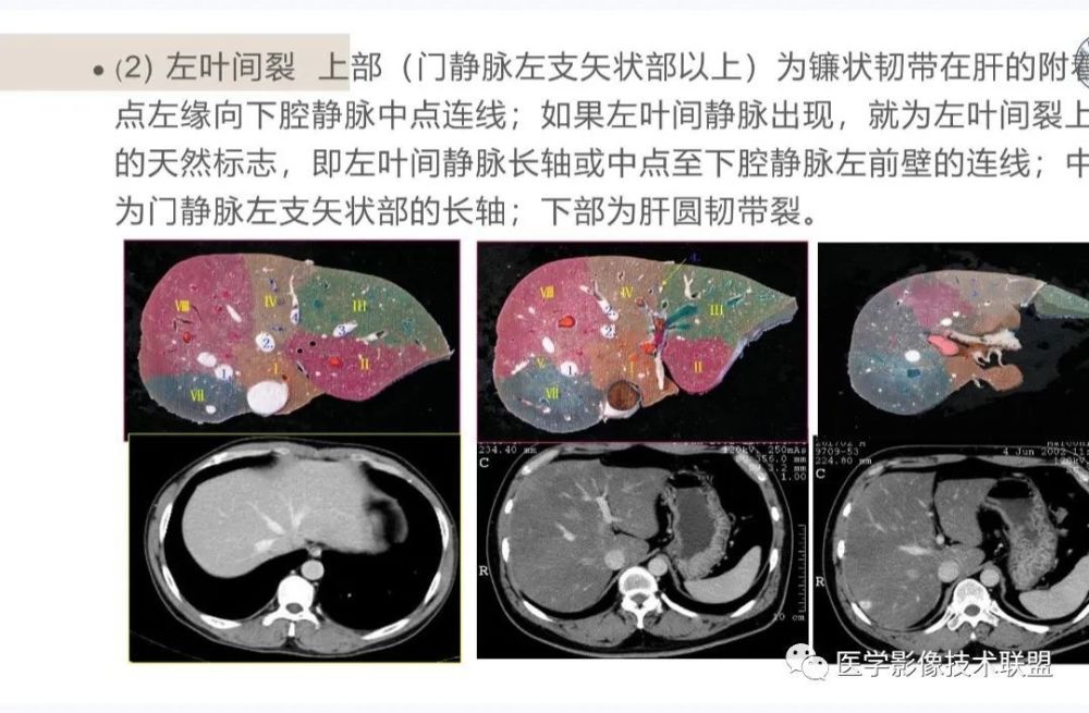 肝臟ct斷層解剖_騰訊新聞