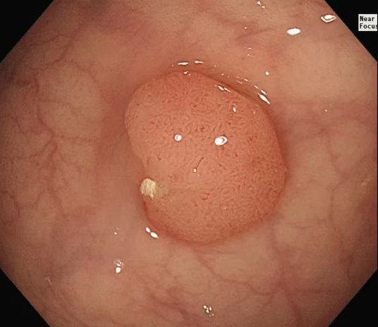 良性肠息肉图片直肠图片