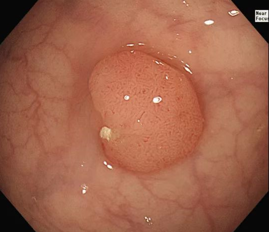 直肠息肉怎么说癌变就癌变了!