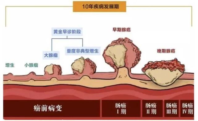 腸息肉的那些事?