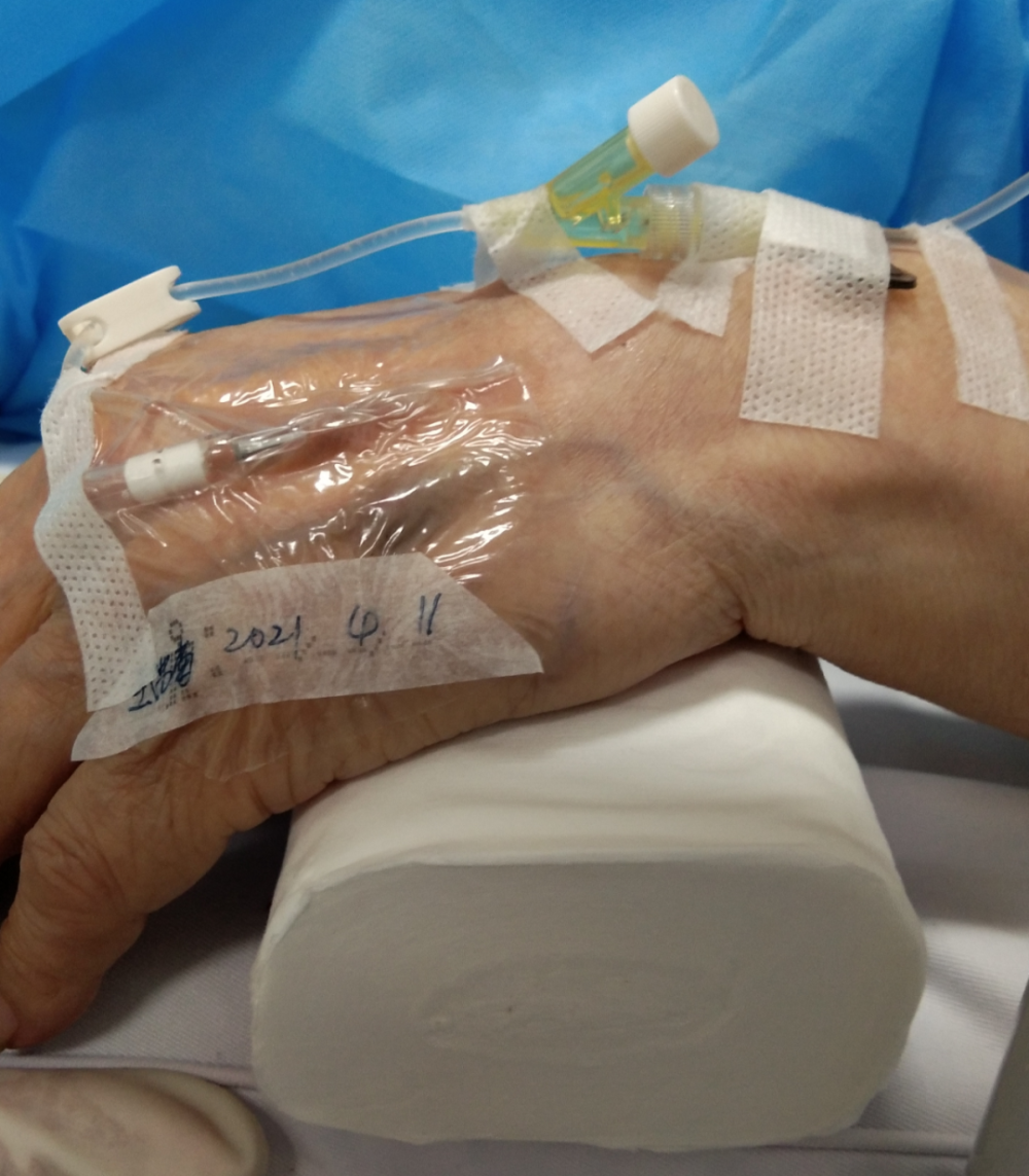 留置针打在这种奇葩位置合适吗?小心摊上大事_腾讯新闻