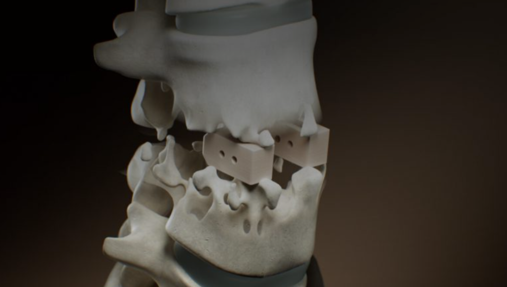 从3d可打印个性化peek脊柱融合器看硬组织植入物新发展趋势_腾讯新闻
