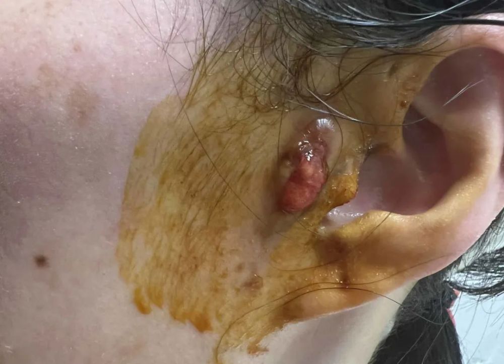 切排处长了肉芽.