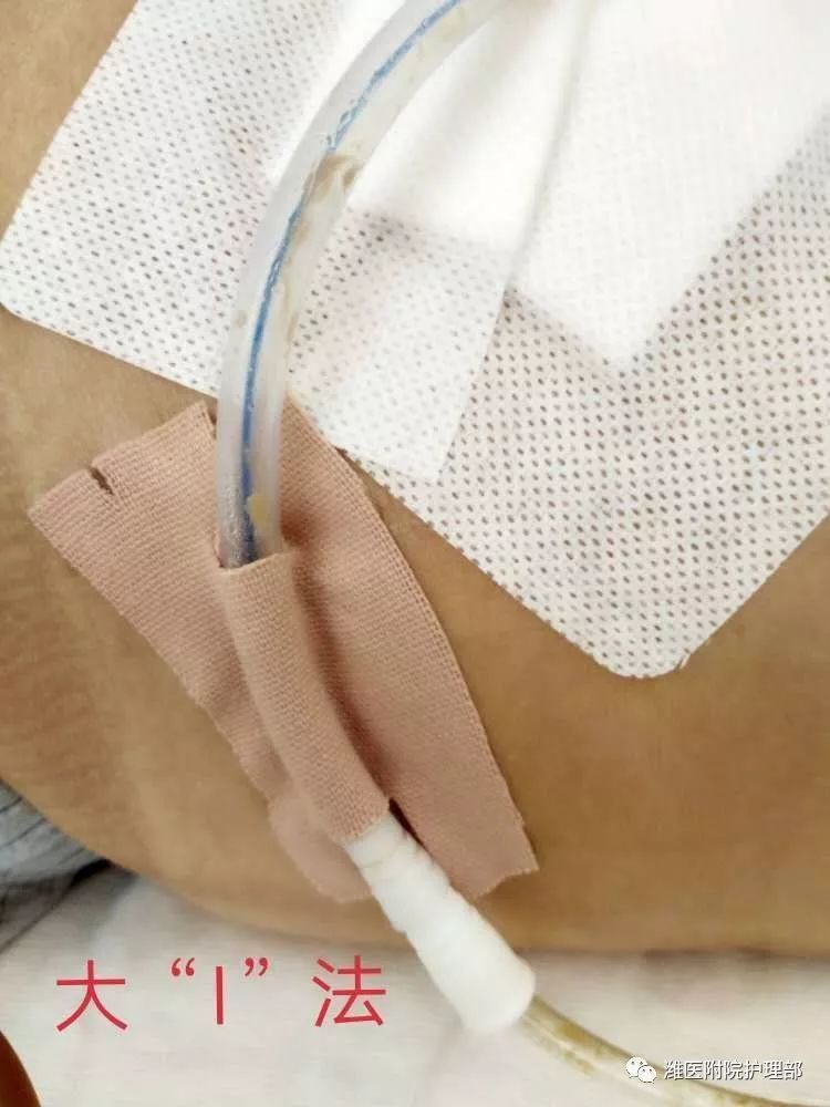 这里有八种引流管固定方法固定的结实又漂亮