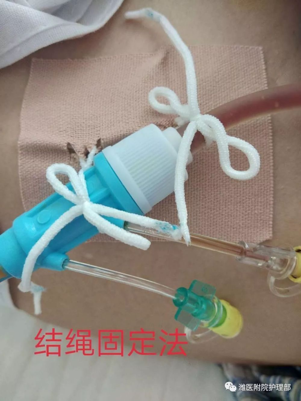 这里有八种引流管固定方法固定的结实又漂亮