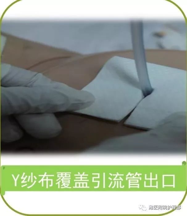 这里有八种引流管固定方法固定的结实又漂亮