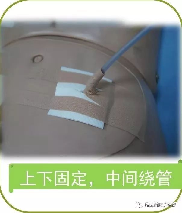 要开始固定引流管啦15床王先生术后返回病房时带了6根管路,分别是胃管