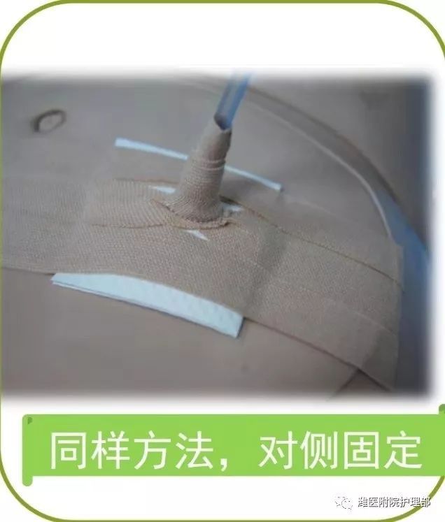 这里有八种引流管固定方法固定的结实又漂亮