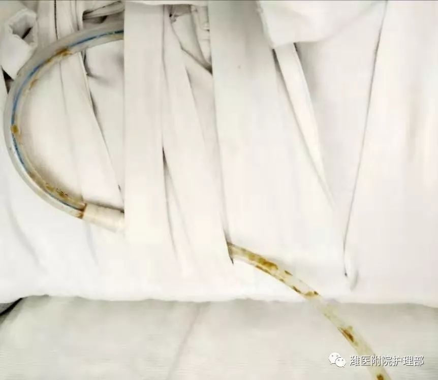 这里有八种引流管固定方法,固定的结实又漂亮!_腾讯新闻