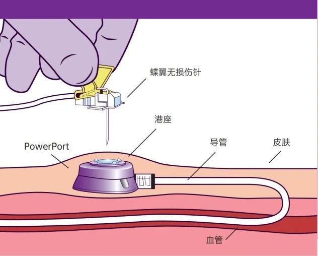 【中靈科普】輸液港,最溫柔的打針方式