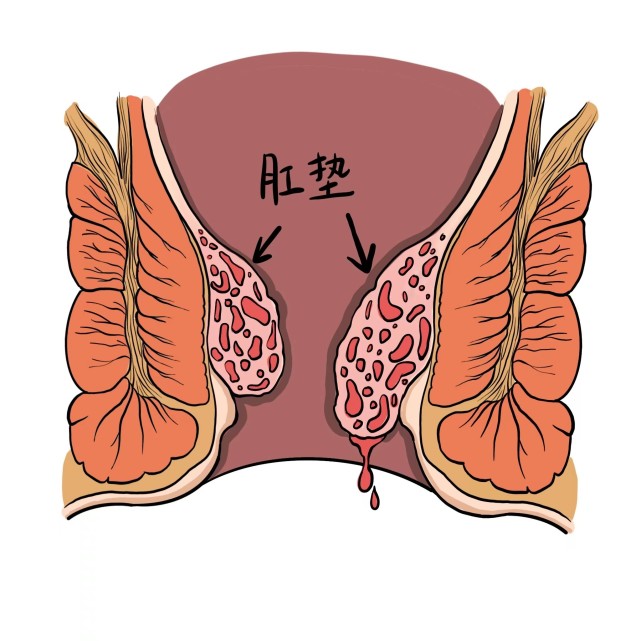 各种原因导致肛垫的弹性减弱后,①肛垫下移目前有两种学说比较受认可