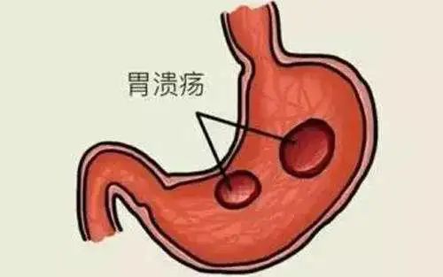 【大连奥林胃肠医院】胃溃疡发生的原因和危害
