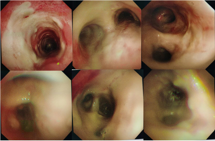 连续三天血 gm 实验曲霉菌细胞壁半乳甘露聚糖实验:1.39,6.65,1.