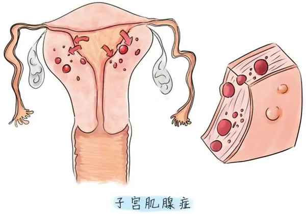 腺肌症能怀孕吗 腾讯网