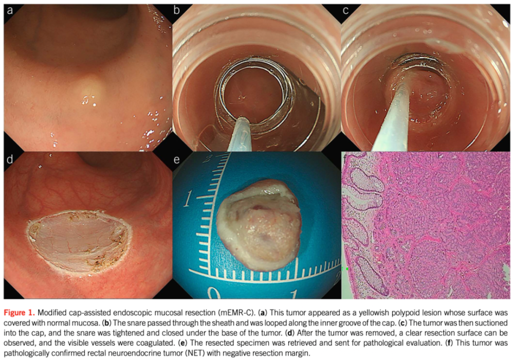 memr-c:改良的透明帽辅助的内镜下黏膜切除术,在内镜前方安置有透明帽
