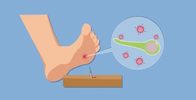 破伤风针,该不该打?该怎么打?