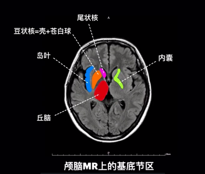 脑基底节区解剖图图片