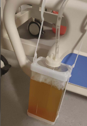 我把引流管夹住,主任大骂:你有没有常识!