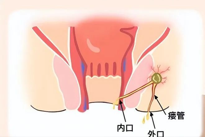 肛瘻是怎麼造成的