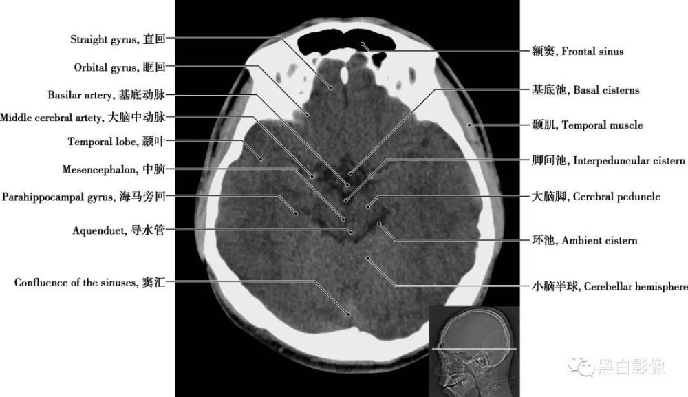 顱腦ct正常解剖圖譜_騰訊新聞