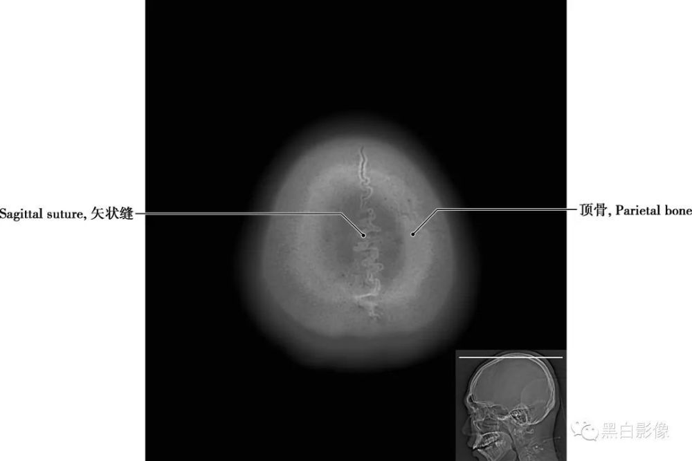 图1-2-1 经顶骨轴位切面顶骨 位于颅盖的中部,左右各一,呈四边形,为外