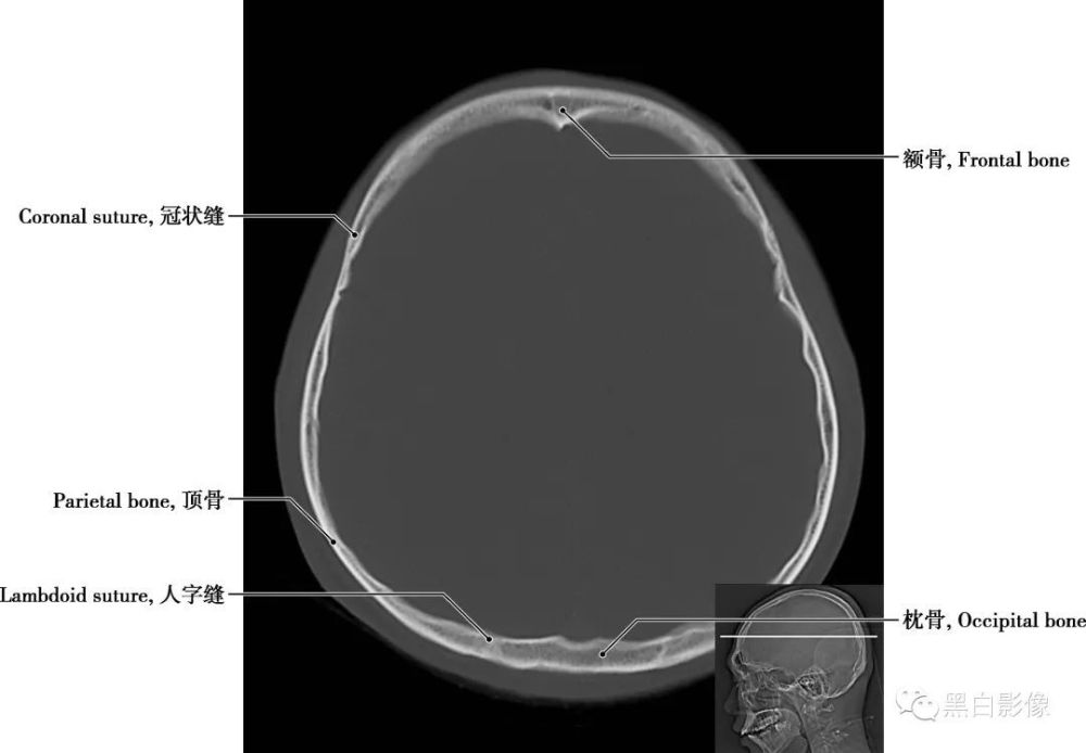 瓢状,其前下部有枕骨大孔,侧部的下方有椭圆形的关节面,称枕髁图1-2-8