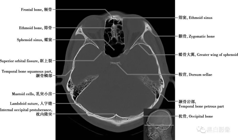 顱腦ct正常解剖圖譜_騰訊新聞