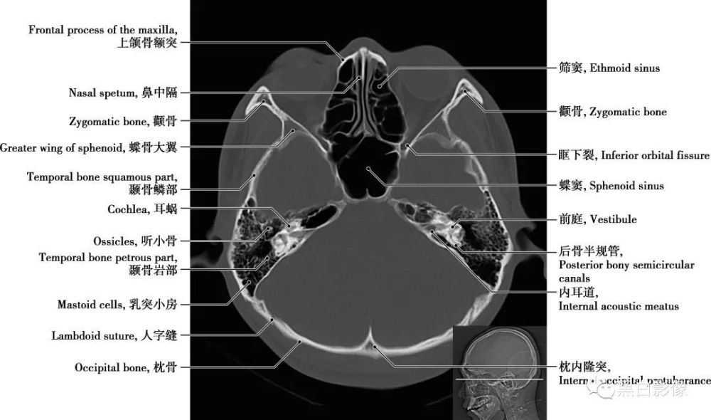 圖1-2-15 經第四腦室下部軸位切面耳蝸 為內耳的一個解剖結構,和前庭