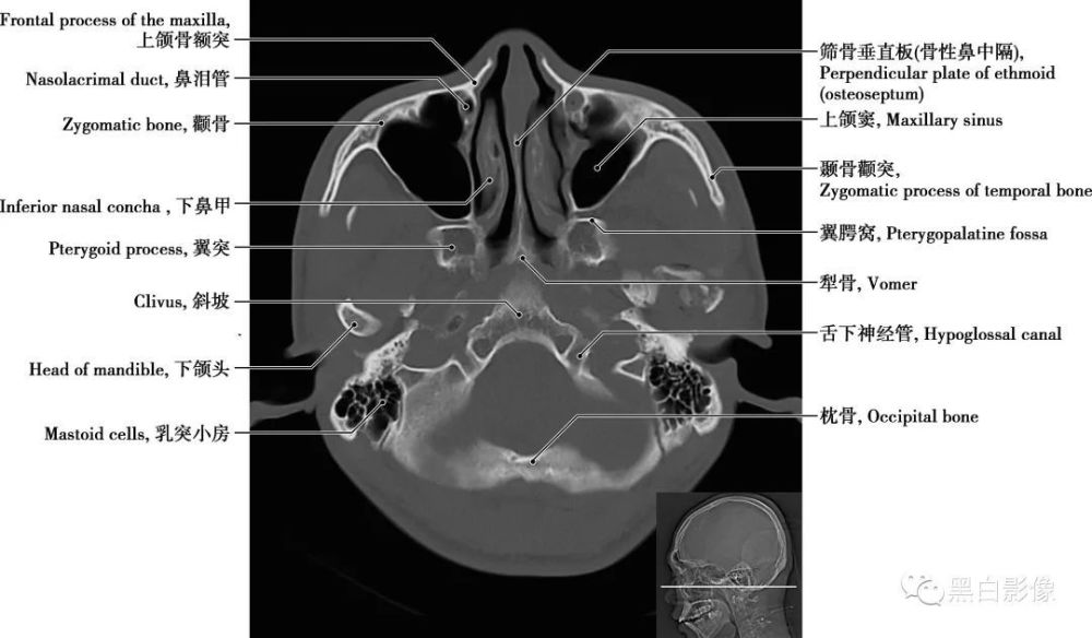 上颌骨体内的锥形空腔,位于上颌骨体内,窦壁为骨质,窦壁覆黏膜,向内侧