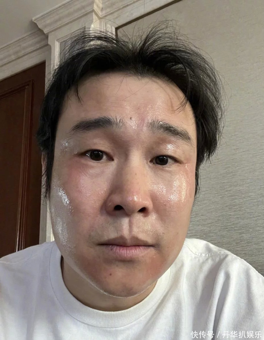 照片中的小沈阳脸部皮肤发红泛肿泛油光,尤其是眉心和两个眼角处还有