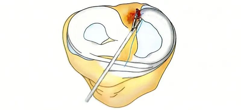 骨科技巧半月板缝合技巧全关节内缝合