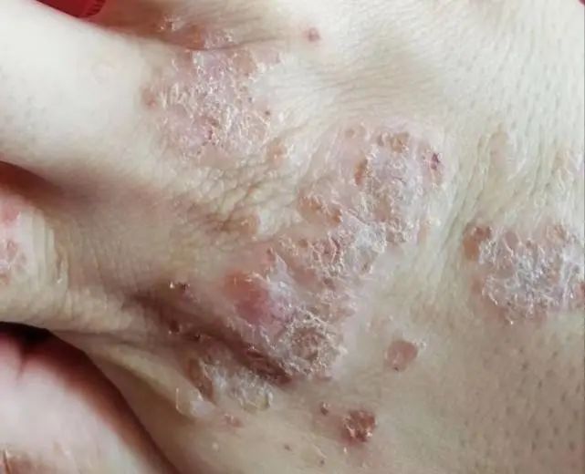 手部湿疹怎么快速消退?_腾讯新闻