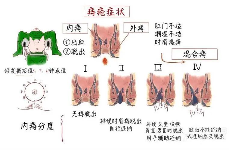 痔疮有哪些常见的症状?_腾讯新闻