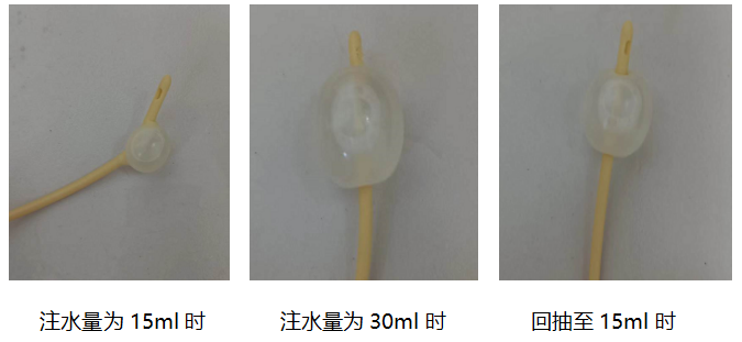 通過實施先注水再回抽的方法,能有效解決因注水方法不當導致留置尿管