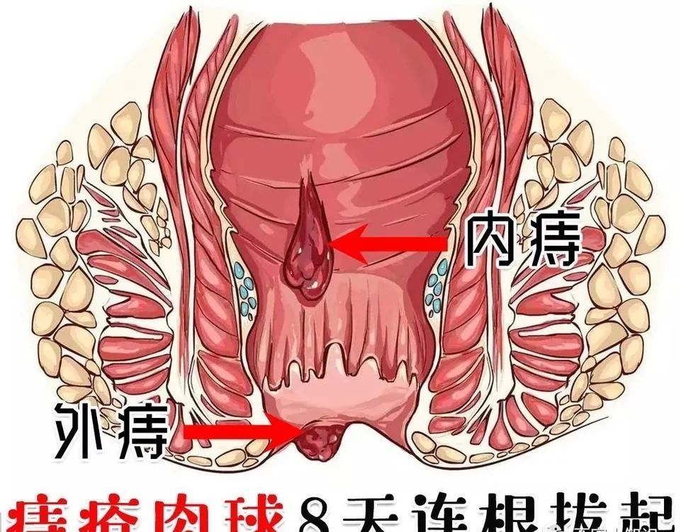 痔瘡肉球的症狀圖片肛腸專家教你在家除肉球