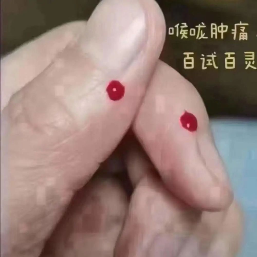 自颈部大椎穴起,沿着脊柱正中从上往下(太阳经脉所过)点刺放血拔罐.