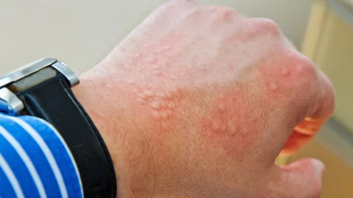 透明"水泡"是什么?有人认为这是体内湿气作怪,有