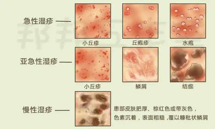 冬季溼疹用什麼藥最有效