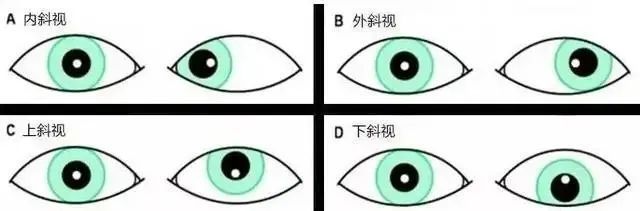 中心凹上,斜视眼则落在中心凹以外的位置,如此视物就会出现复视情形
