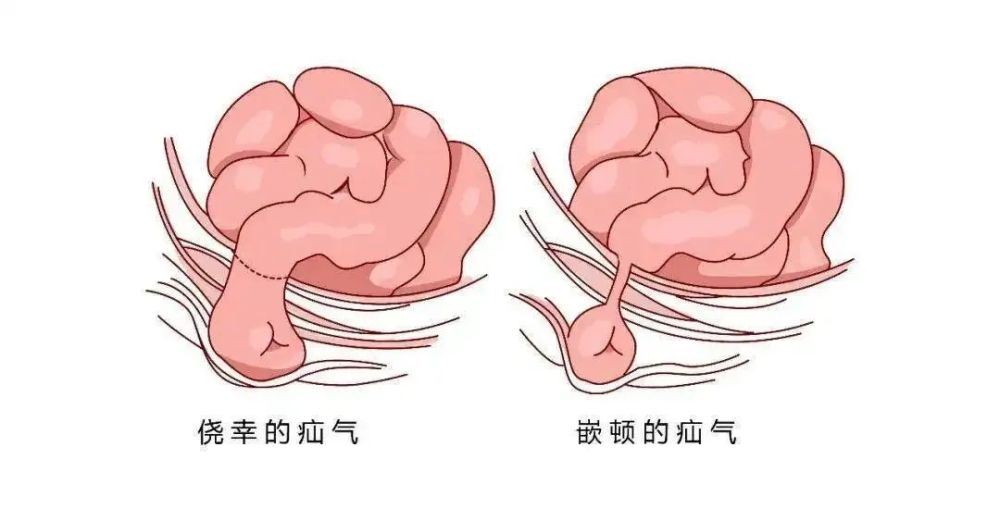 一文读懂疝气的那些事