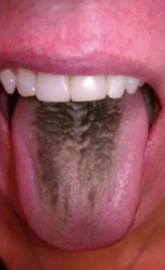 舌头上长毛刺图片图片