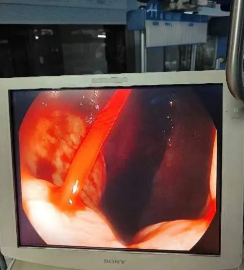 新冠阳性患者消化道大出血,内镜止血显神威,助其转危为安_腾讯新闻