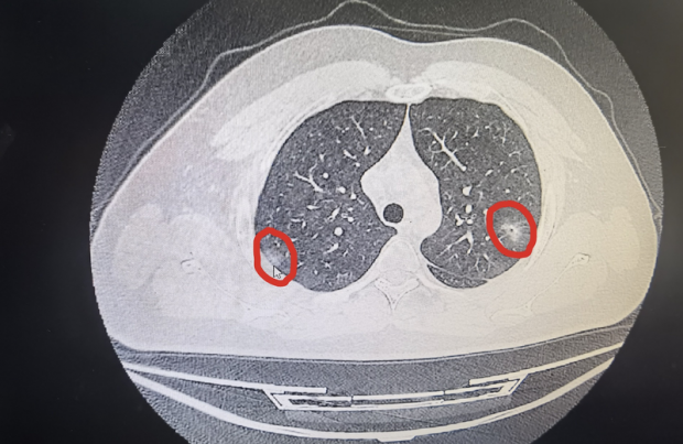 我"白肺"了?杭州不少人跑去医院检查